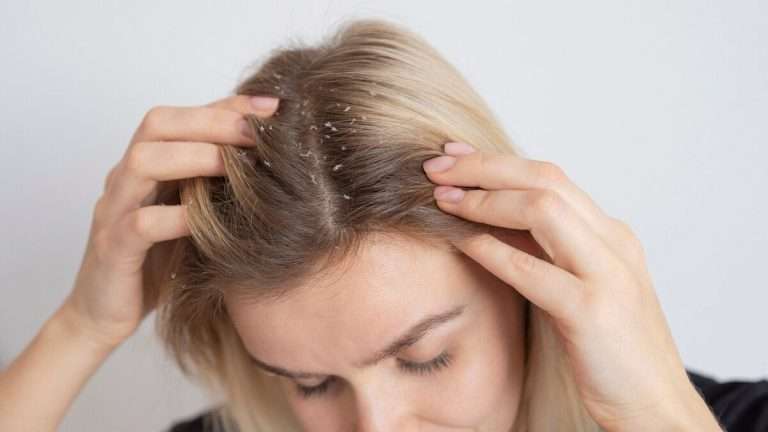 Follow these 5 tips to control dandruff in winter , you will get relief soon